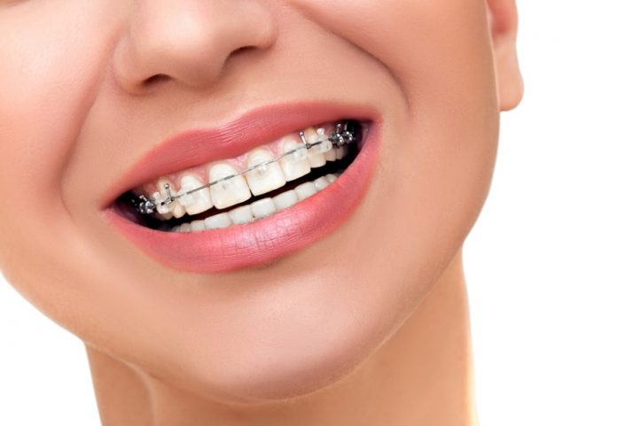 Un ortodont bun este foarte important de consultat inclusiv de către adulți